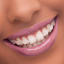 BRACKET ICERAM SAFIRA MBT ORTHOMETRIC KIT 1/1